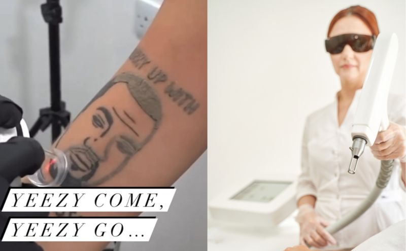tattoo of kanye west in the process of being removed, alongside a photo of a woman operating a laser tattoo removal machine